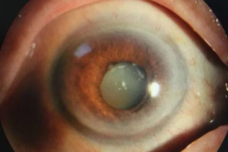 白内障分期分为四期图片