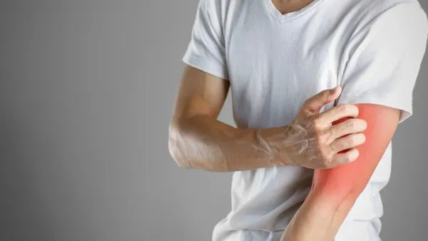 如何修复红血丝皮肤