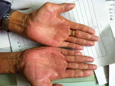 镍皮炎手掌丘疹图片