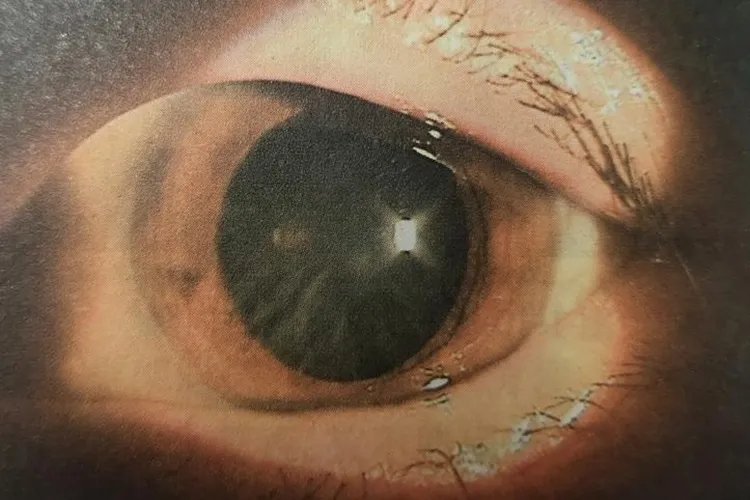 白内障分期分为四期图片