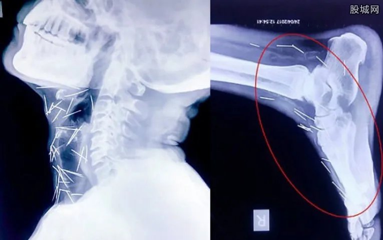 体内被插75根针 真相究竟是怎样的呢
