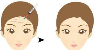 注射botox除皱要注意什么