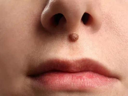 无痛去痣需要注意什么