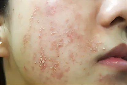 美白针后遗症图片