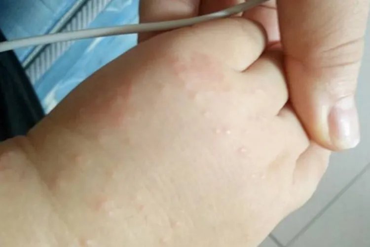 宝宝疥疮初期图片