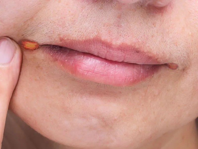 上嘴唇发干怎么办