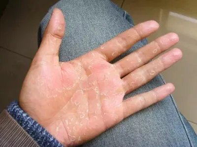 3级手足综合征手掌皲裂图片