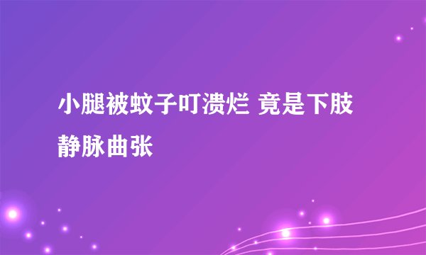 小腿被蚊子叮溃烂 竟是下肢静脉曲张