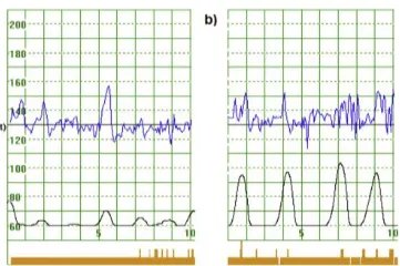 怎么看胎监报告单图