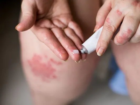 金霉素软膏的副作用