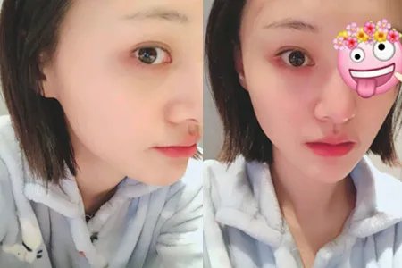 郑爽受伤后首亮相 眼睛裹着厚厚的纱布