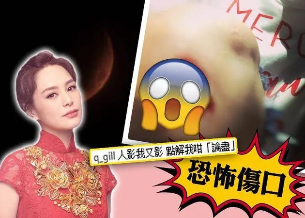 阿娇为拍月食摔跤：伤口似乎挺严重，这么大个口子