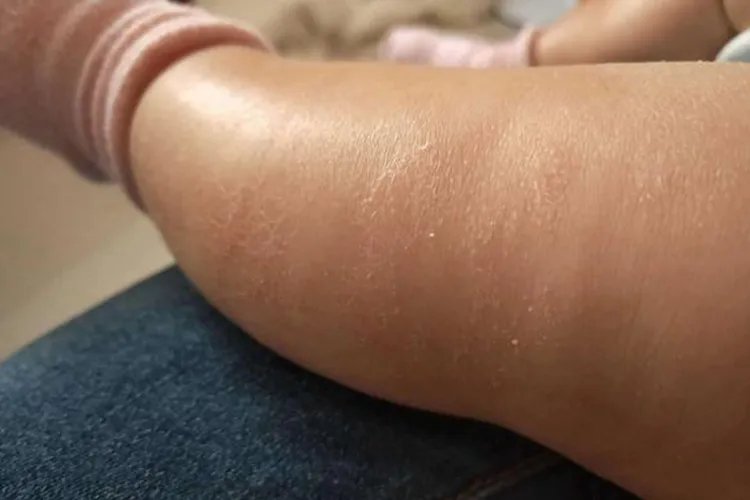 宝宝皮肤干燥起皮图片