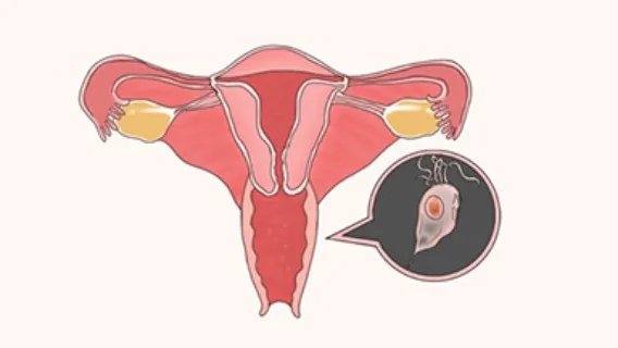 什么是阴道血管肉瘤