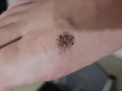 恶性雀斑样痣黑斑图片
