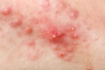 怎么才能赶走痘痘 分享三大去痘法