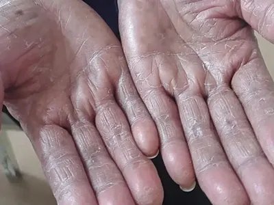 3级手足综合征手掌皲裂图片