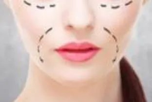 咬肌手术要多少钱