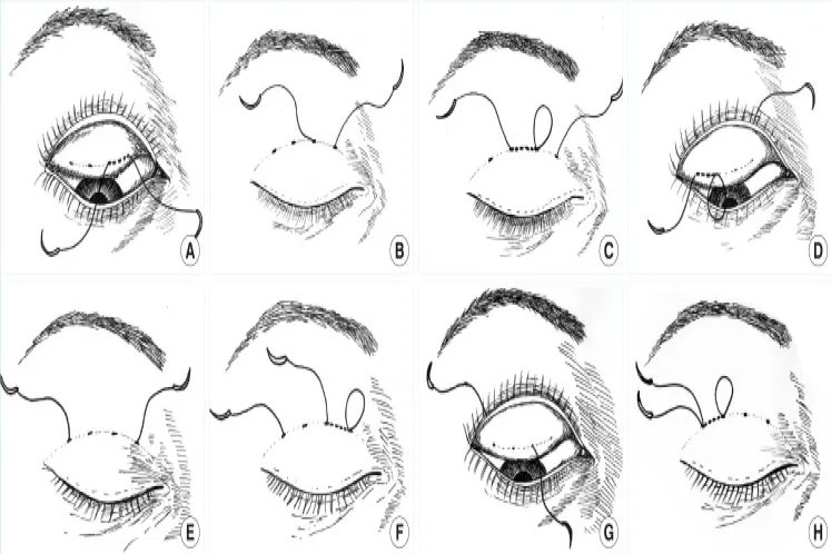 全切双眼皮缝合图解