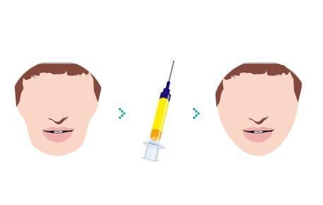 打了4支玻尿酸填充脸颊好吗