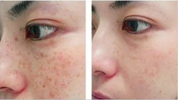 复合彩光治疗多少钱