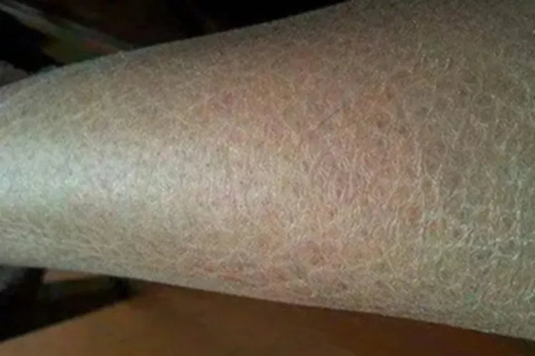 皮脂缺乏症皲裂图片