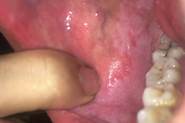 轻度白斑早期症状图片