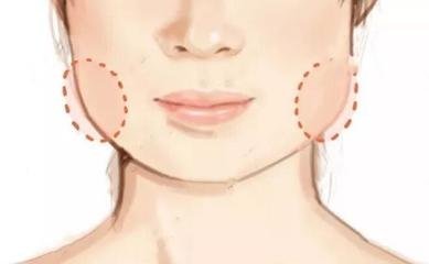 打了4支玻尿酸填充脸颊好吗