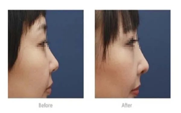 北京做耳软骨隆鼻好的医院在哪里