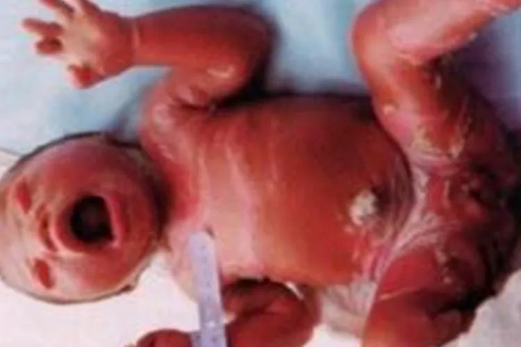 小婴儿轻微鱼鳞病图片