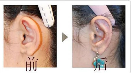 杯状耳整形价格