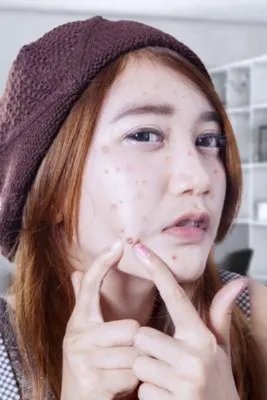 如何预防痤疮呢？