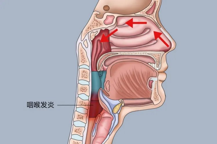 新冠嗓子症状图片