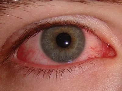 急性发热性皮肤黏膜淋巴结综合征充血图片