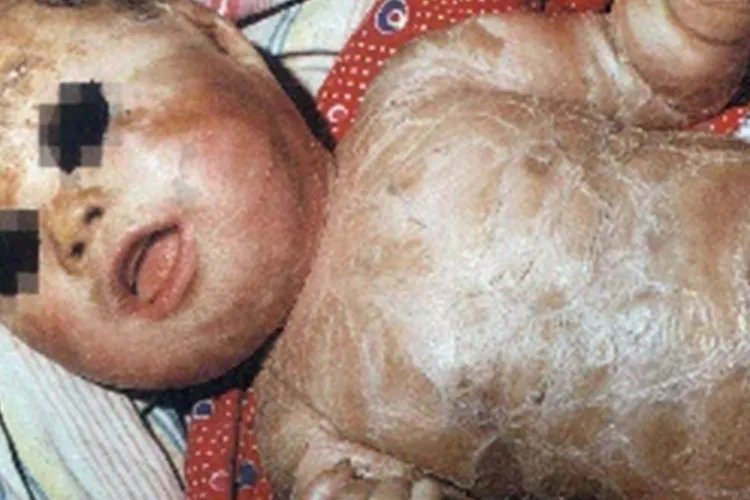 小婴儿轻微鱼鳞病图片