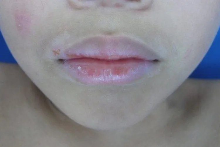 嘴唇边缘白了一圈图片