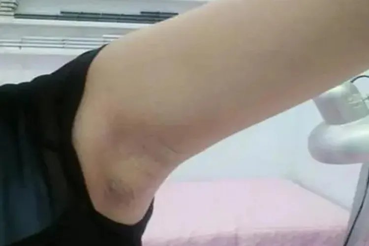 乳腺癌术后腋窝水肿图片