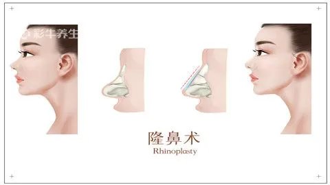 什么是耳软骨隆鼻