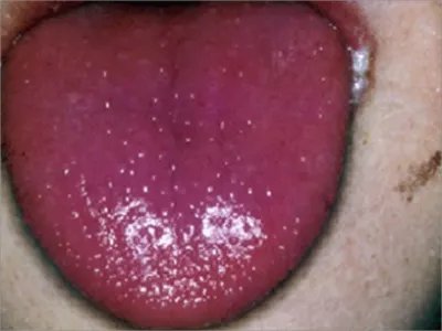 急性发热性皮肤黏膜淋巴结综合征充血图片