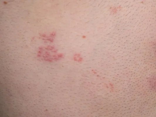 白糖水去痘印是否有效