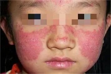 红斑狼疮症状初期图片