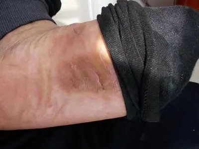 浸渍足脚底皮肤颜色加深图片