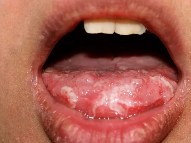 口腔白色念珠菌病的症状