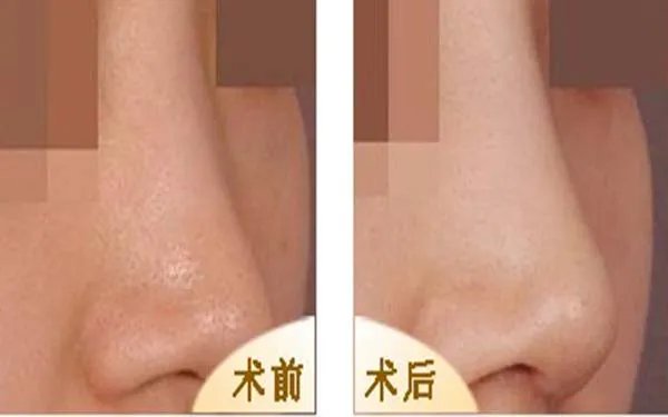 北京做耳软骨隆鼻好的医院在哪里