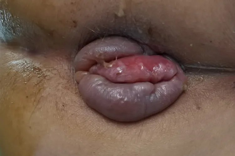 什么是痔疮图片