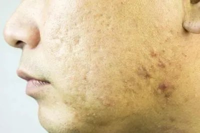 如何去除痘坑和痘疤