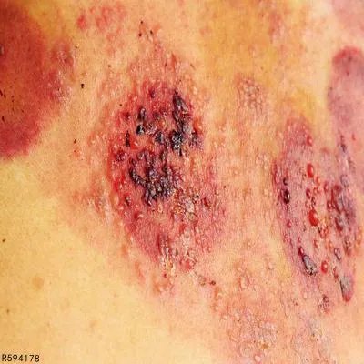 被烧伤应该怎么处理