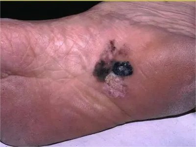 恶性雀斑样痣黑斑图片