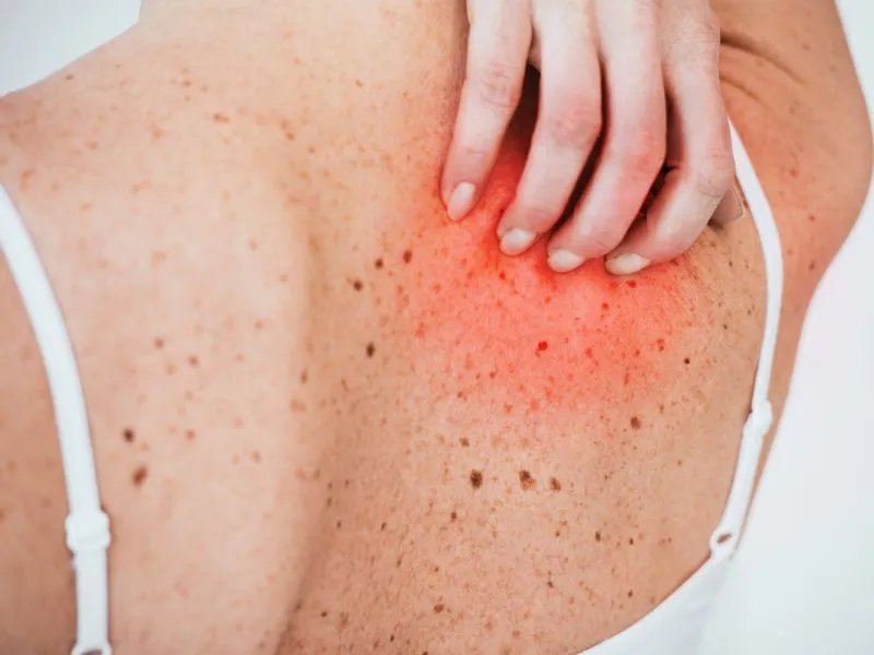 身上起红疙瘩不痒怎么回事