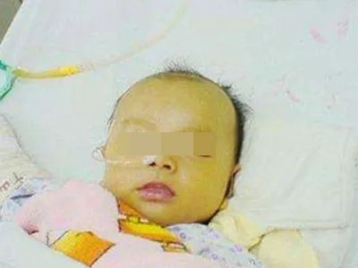 蚕豆病症状图片